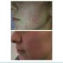 The world’s Golden standard for medical grade micro needling
For anti aging collagen induction and pigmentation treatment The world’s Golden standard for medical grade micro needling
For anti aging collagen induction and pigmentation treatment