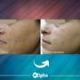 Diode Laser hair removal and 3D ipl
Our high technology diode laser and Alpha dual system is broad spectrum machine that is safe for all skin types and colours with unique milometer to measure exact skin tone for safer session Diode Laser hair removal and 3D ipl
Our high technology diode laser and Alpha dual system is broad spectrum machine that is safe for all skin types and colours with unique milometer to measure exact skin tone for safer session