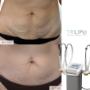Body contouring and cellulite reduction and face lifting
Our Trilipo MAXIMUS
the world’s leading machine that combines both RF and DMA to melt fats removes cellulites and tone the muscles in a very natural and healthy way Body contouring and cellulite reduction and face lifting
Our Trilipo MAXIMUS
the world’s leading machine that combines both RF and DMA to melt fats removes cellulites and tone the muscles in a very natural and healthy way
