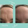 Body contouring and cellulite reduction and face lifting
Our Trilipo MAXIMUS
the world’s leading machine that combines both RF and DMA to melt fats removes cellulites and tone the muscles in a very natural and healthy way Body contouring and cellulite reduction and face lifting
Our Trilipo MAXIMUS
the world’s leading machine that combines both RF and DMA to melt fats removes cellulites and tone the muscles in a very natural and healthy way