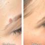 Freeze pen
Medical grade device based on nitrogen cryotherapy to Safely Removes all benign skin lesions with no scars left Freeze pen
Medical grade device based on nitrogen cryotherapy to Safely Removes all benign skin lesions with no scars left