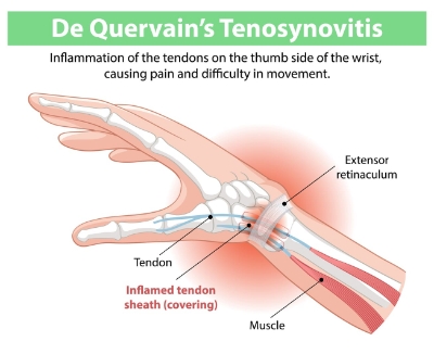 De Quervain's Tendinosis (Tenosynovitis)