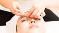 Acupuncture