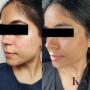 THIS... This is why we do what we do!
6 month before and after from following our product recommendations. Our client has also had 3 dermaplaning facials, 4 weeks apart, and a plan to come in for monthly maintenance treatments. THIS... This is why we do what we do!
6 month before and after from following our product recommendations. Our client has also had 3 dermaplaning facials, 4 weeks apart, and a plan to come in for monthly maintenance treatments.