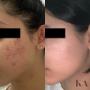 Like we always say... results driven.
This before and after is a one year journey that. included a transition from drugstore skin care to medical grade.
Have you tried everything to clear your skin but nothing has worked? We'd love to help! Like we always say... results driven.
This before and after is a one year journey that. included a transition from drugstore skin care to medical grade.
Have you tried everything to clear your skin but nothing has worked? We'd love to help!