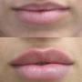 Lip injection with lip filler enhances your lips. Lip injection with lip filler enhances your lips.