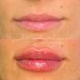 Before & after lip fillers - Clinique Esthétique HoMa Before & after lip fillers - Clinique Esthétique HoMa