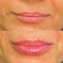 Before & after lip fillers - Clinique Esthétique HoMa Before & after lip fillers - Clinique Esthétique HoMa