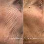 Before & after Skinboosters - Clinique Esthétique HoMa Before & after Skinboosters - Clinique Esthétique HoMa