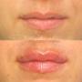 Before & after lip fillers - Clinique Esthétique HoMa Before & after lip fillers - Clinique Esthétique HoMa