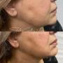 Before & after chin & jawline fillers - Clinique Esthétique HoMa Before & after chin & jawline fillers - Clinique Esthétique HoMa