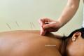 Acupuncture-Keswick-Ontar