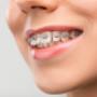 Braces in Burlington Braces in Burlington