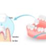 Dental Crowns in Burlington Dental Crowns in Burlington