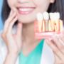 Dental Implants in Burlington Dental Implants in Burlington