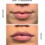 LIP FILLERS
APPOINTMENT AVAILABLE FOR JUNE 26TH
CALL US TO BOOK YOUR SLOT??
905-856-8770
OR TEXT US ??
833-455-4222 LIP FILLERS
APPOINTMENT AVAILABLE FOR JUNE 26TH
CALL US TO BOOK YOUR SLOT??
905-856-8770
OR TEXT US ??
833-455-4222