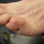 *Swollen, Painful, and Unsightly*
Corns are thick-calloused lesions that usually form under a bony pressure point. They are the body?s way of forming a natural cushion against the rubbing of shoes or other bones. *Swollen, Painful, and Unsightly*
Corns are thick-calloused lesions that usually form under a bony pressure point. They are the body?s way of forming a natural cushion against the rubbing of shoes or other bones.