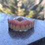 COMPLETE UPPER PRECISION DENTURE COMPLETE UPPER PRECISION DENTURE