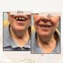 Journey of smile and confidence that our patients regain with their new teeth ?? Journey of smile and confidence that our patients regain with their new teeth ??