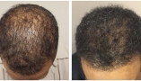 hair-restore-before-after-image-two hair-restore-before-after-image-two