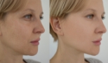 red-carpet-laser-facial-before-after-one red-carpet-laser-facial-before-after-one