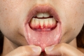Gum Treatment